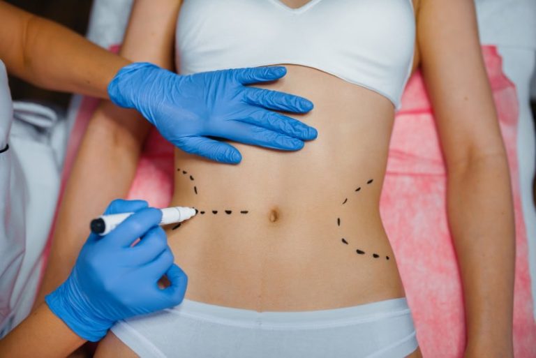 Las Últimas Tendencias en Abdominoplastia