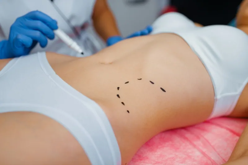 Las Últimas Tendencias en Abdominoplastia