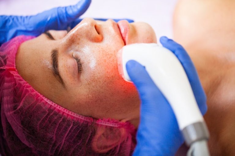 Rejuvenecimiento facial con láser: descubre cómo el Láser Fractora transforma tu piel