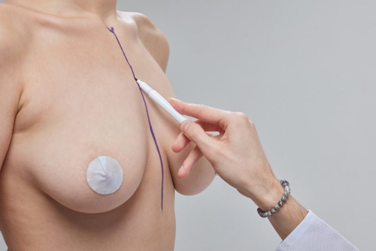 Corrección de implantes mamarios: soluciones efectivas para resultados insatisfactorios