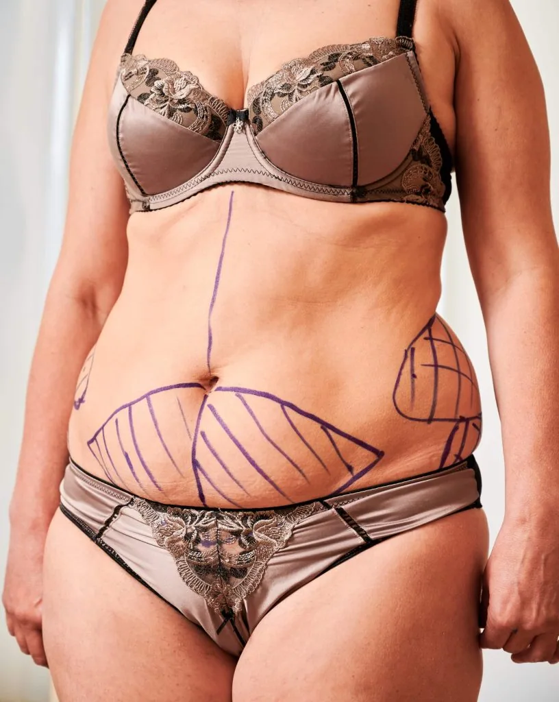 quitar piel sobrante abdomen