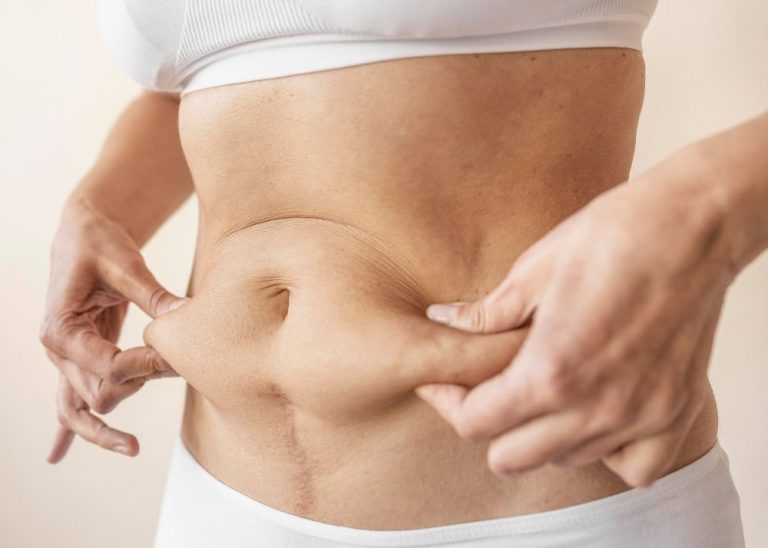 Diástasis de rectos abdominales: síntomas, diagnóstico y opciones de tratamiento eficaz