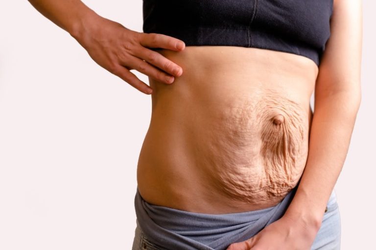 ¿Has adelgazado mucho sin hacer nada y ahora tienes exceso de piel?