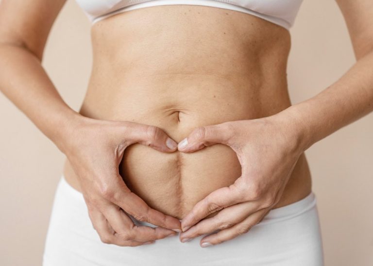 Lo que debes saber de la cicatriz tras una operación de diástasis abdominal
