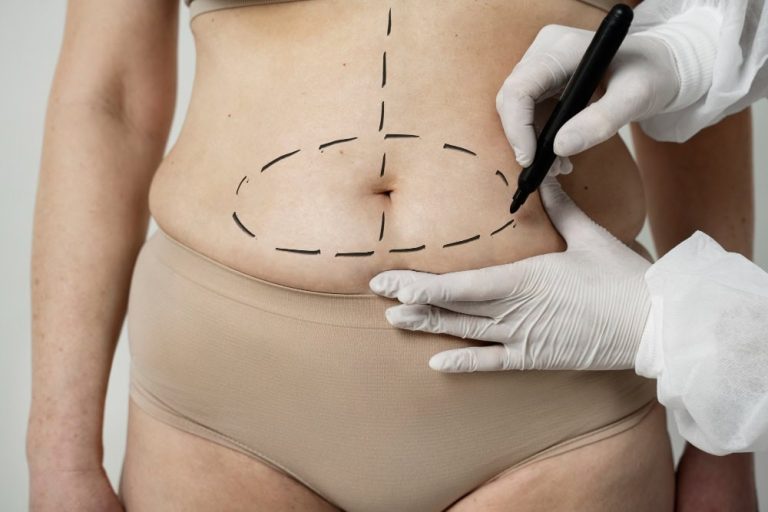 Operaciones de barriga: cuándo elegir una abdominoplastia y qué resultados puedes esperar