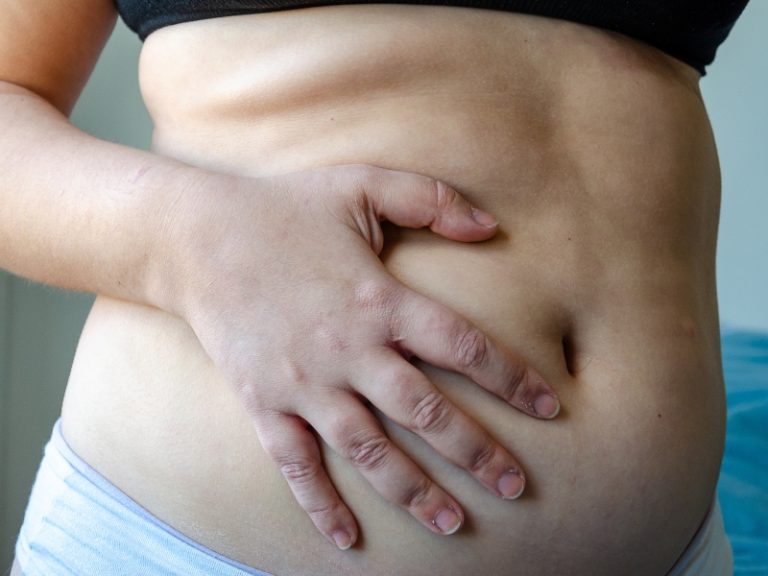 Barriga con diástasis abdominal: ¿Cuándo es necesario recurrir a la cirugía?