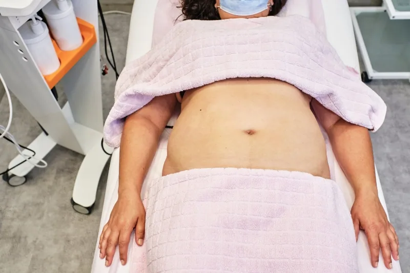 Barriga con diástasis abdominal: ¿Cuándo es necesario recurrir a la cirugía? en Málaga | Dr. César Padilla