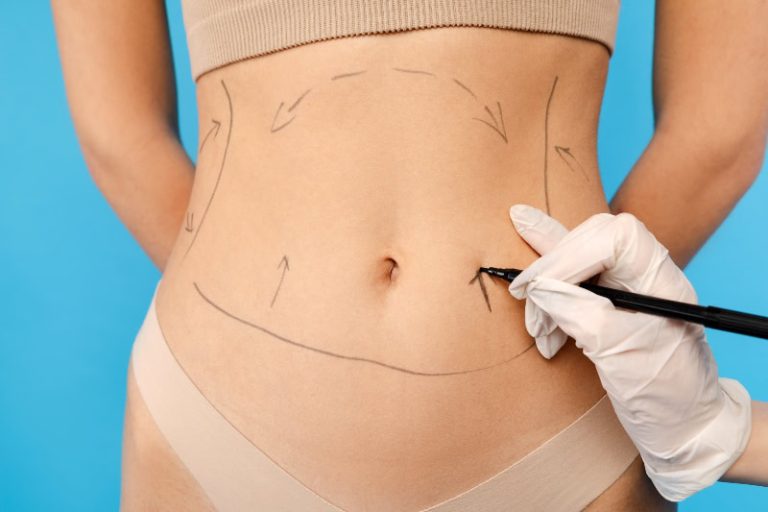 Lipoescultura 360: resultados antes y después del tratamiento