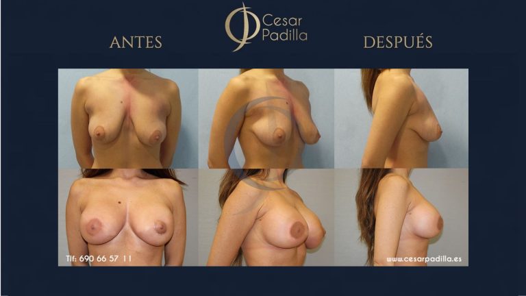 Mastopexia sin implantes: resultados naturales y definición del pecho
