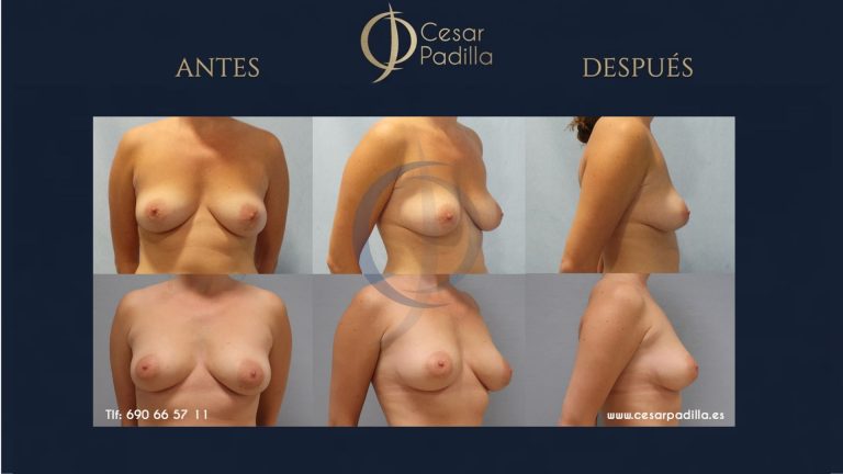 Senos cicatriz mastopexia 6 meses: cómo lucen tras la recuperación