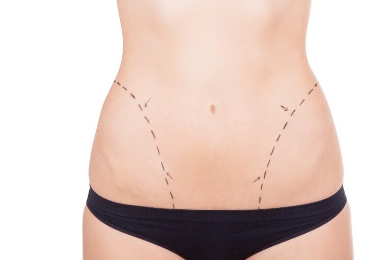 Abdomen plano con abdominoplastia: ¿qué esperar y cómo lograrlo?