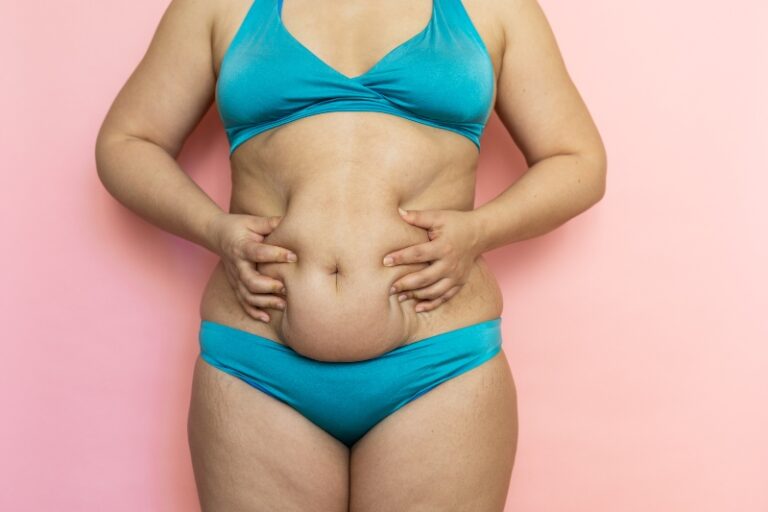 Si pierdo 20 kilos me quedan colgajos: ¿cuándo es necesaria la cirugía de piel sobrante?