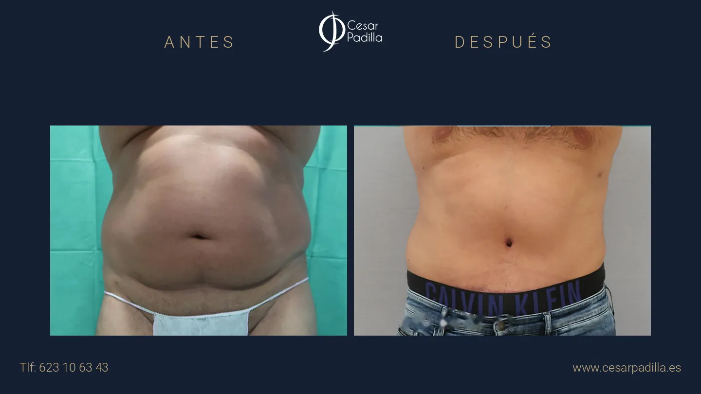 Antes y después de abdominoplastia masculina, caso 2