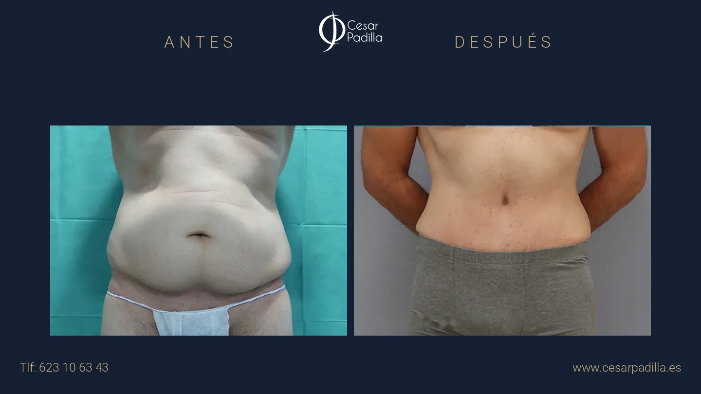 Antes y después de abdominoplastia masculina, caso 4