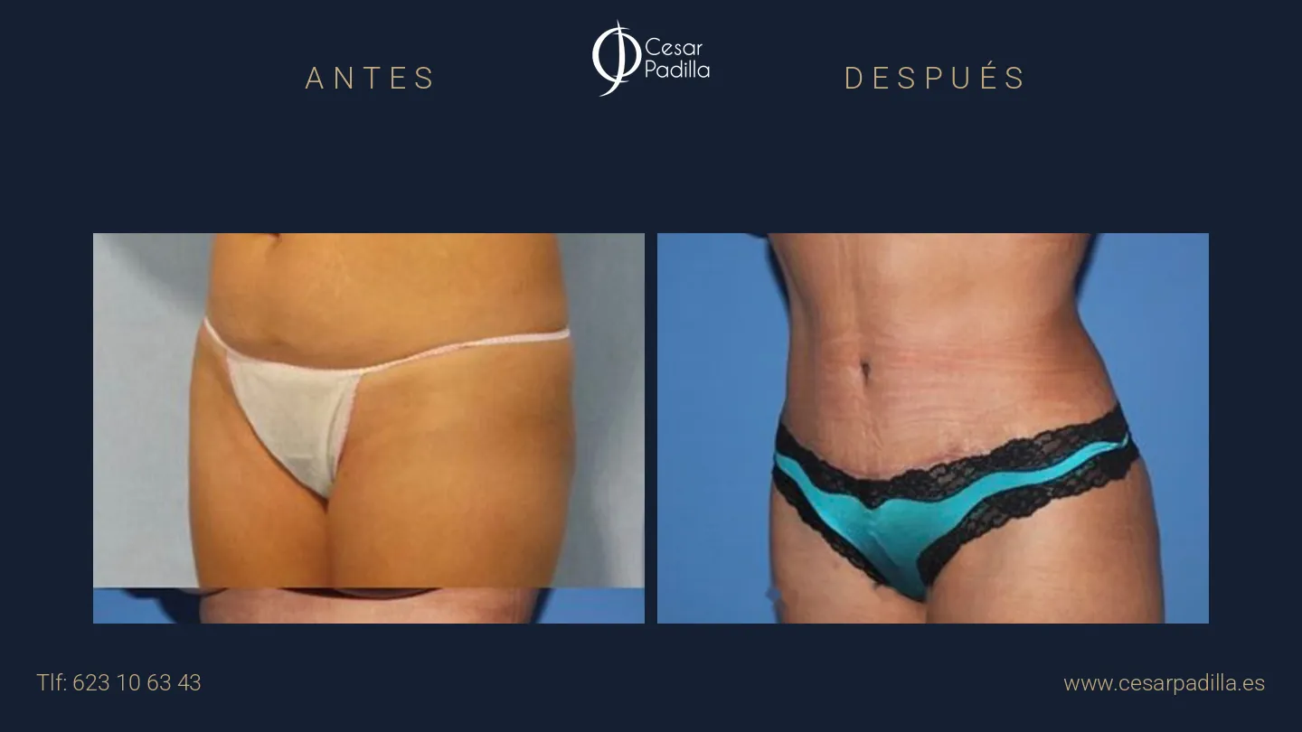 Abdominoplastia