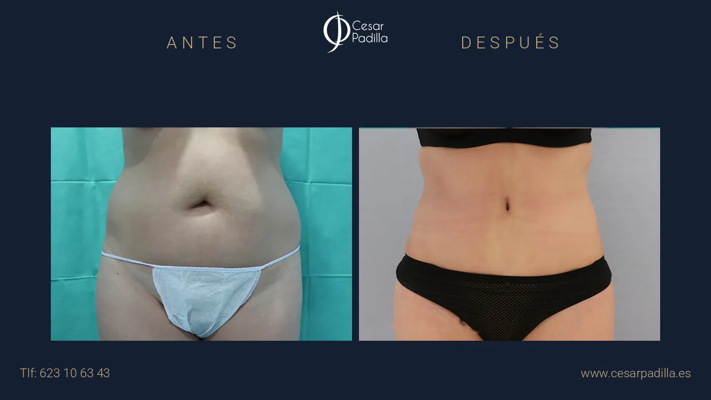 Antes y después de abdominoplastia, caso 10