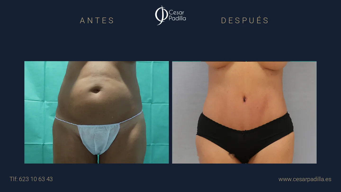 Antes y después de abdominoplastia, caso 11