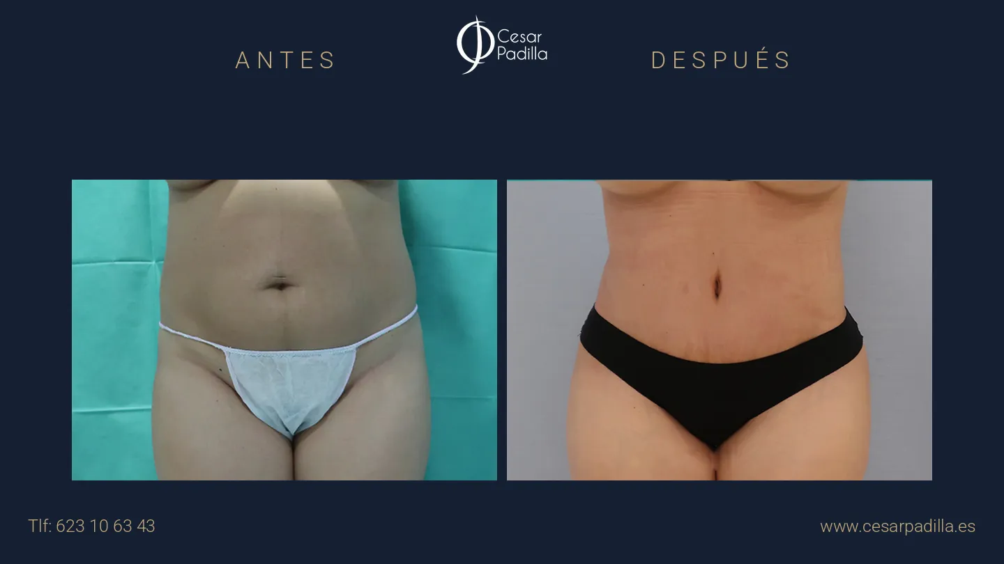 Antes y después de abdominoplastia, caso 12