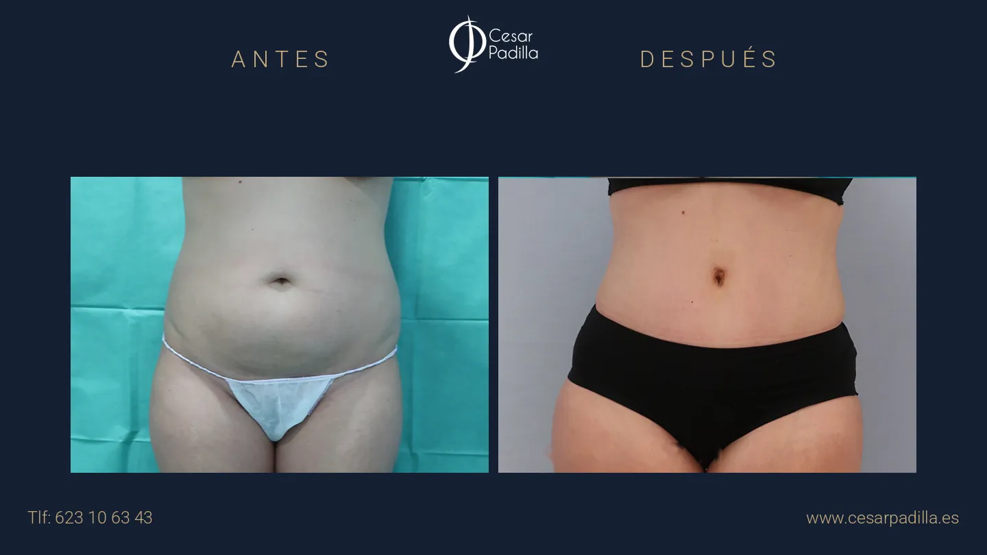 Antes y después de abdominoplastia, caso 13