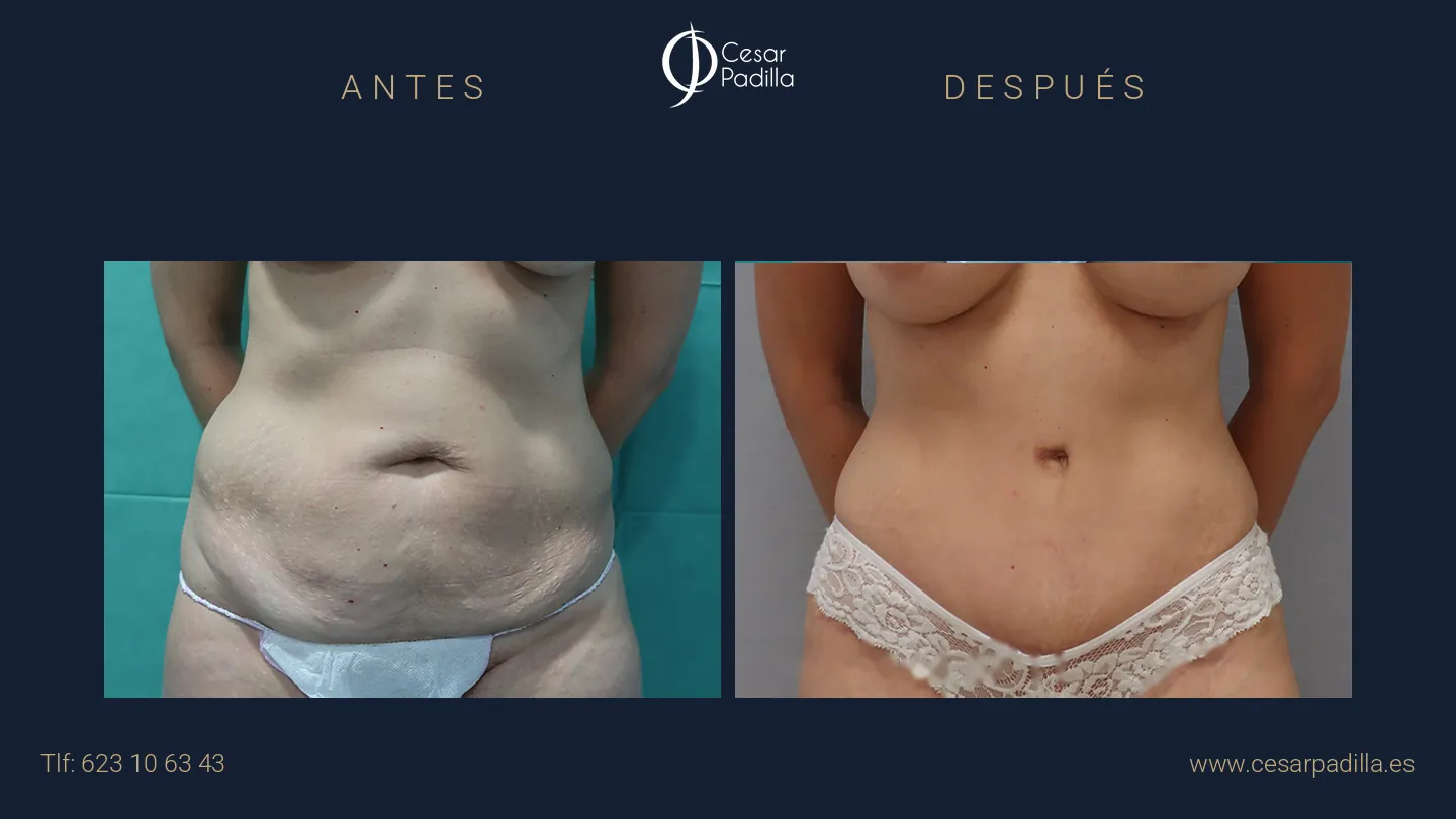 Antes y después de abdominoplastia, caso 14