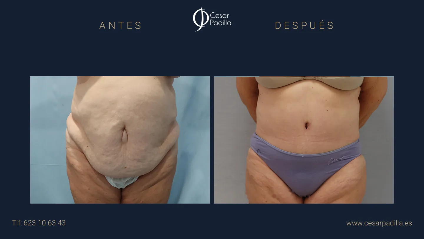 Antes y después de abdominoplastia, caso 15