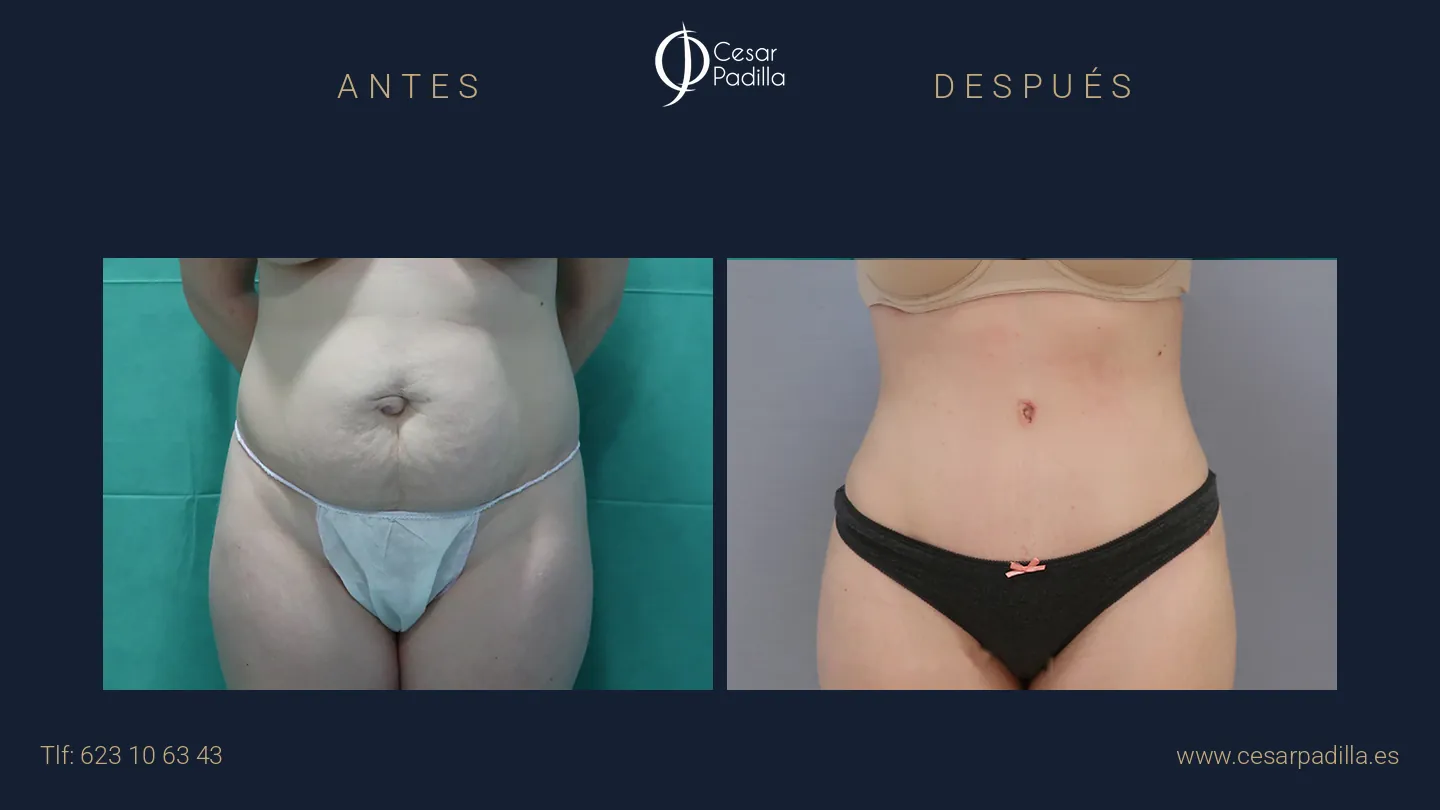 Antes y después de abdominoplastia, caso 16