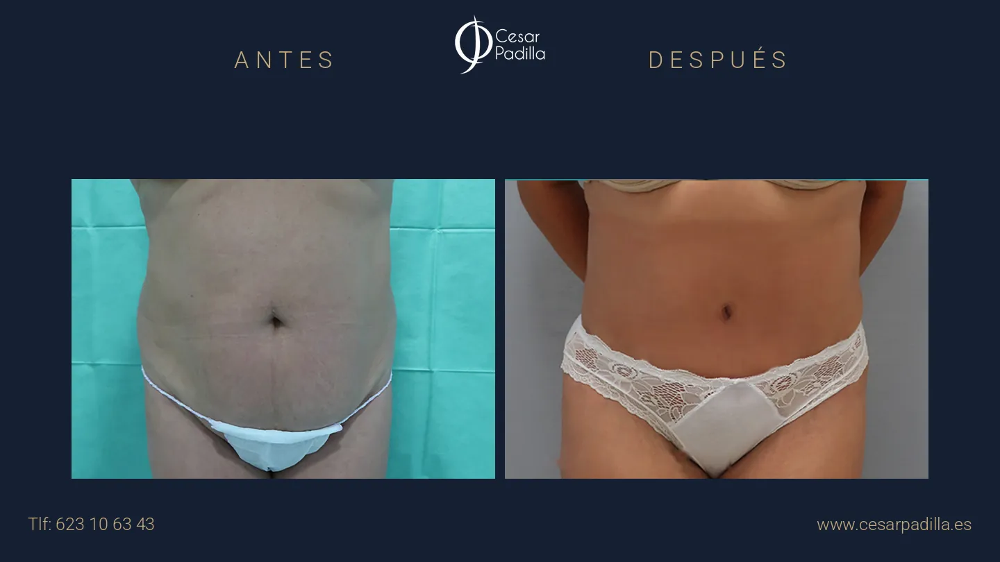 Antes y después de abdominoplastia, caso 17
