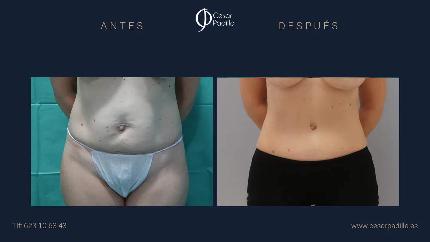 Antes y después de abdominoplastia, caso 18