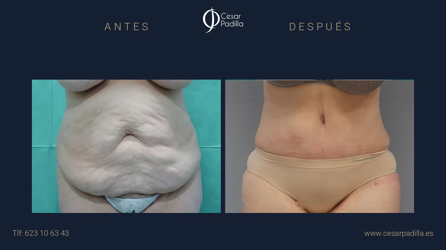Antes y después de abdominoplastia, caso 19