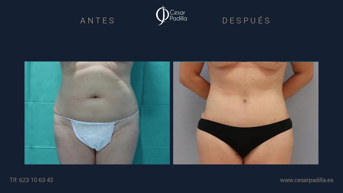 Antes y después de Abdominoplastia