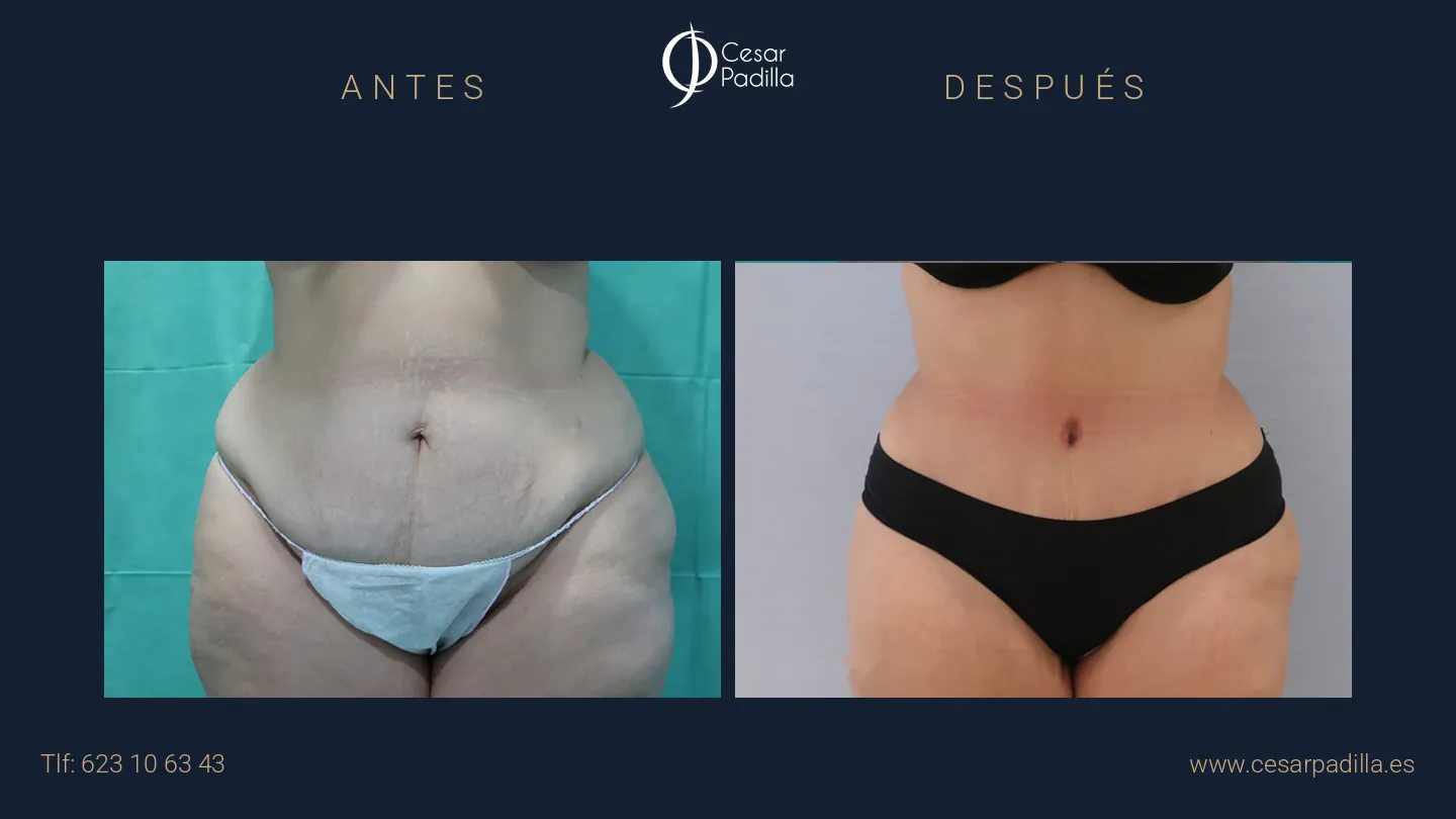 Antes y después de abdominoplastia, caso 20