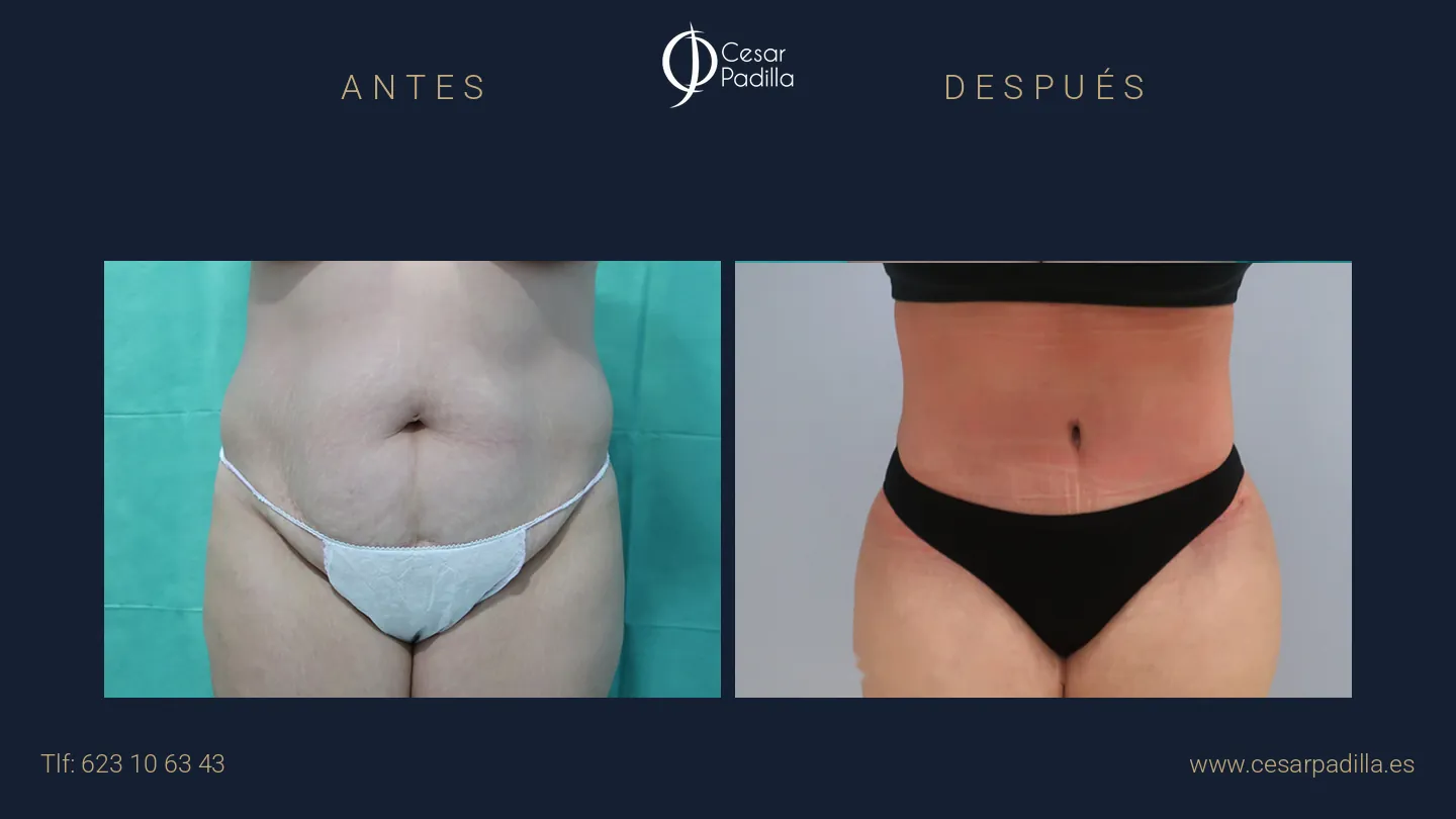 Antes y después de abdominoplastia, caso 21