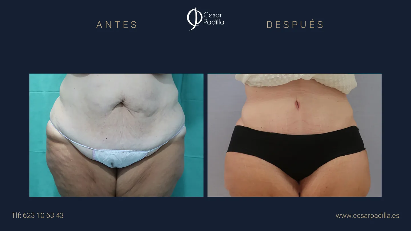 Antes y después de abdominoplastia, caso 22