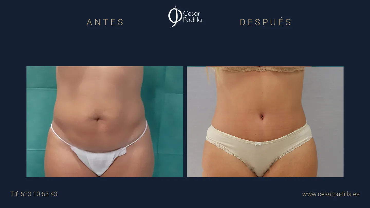 Antes y después de abdominoplastia, caso 23