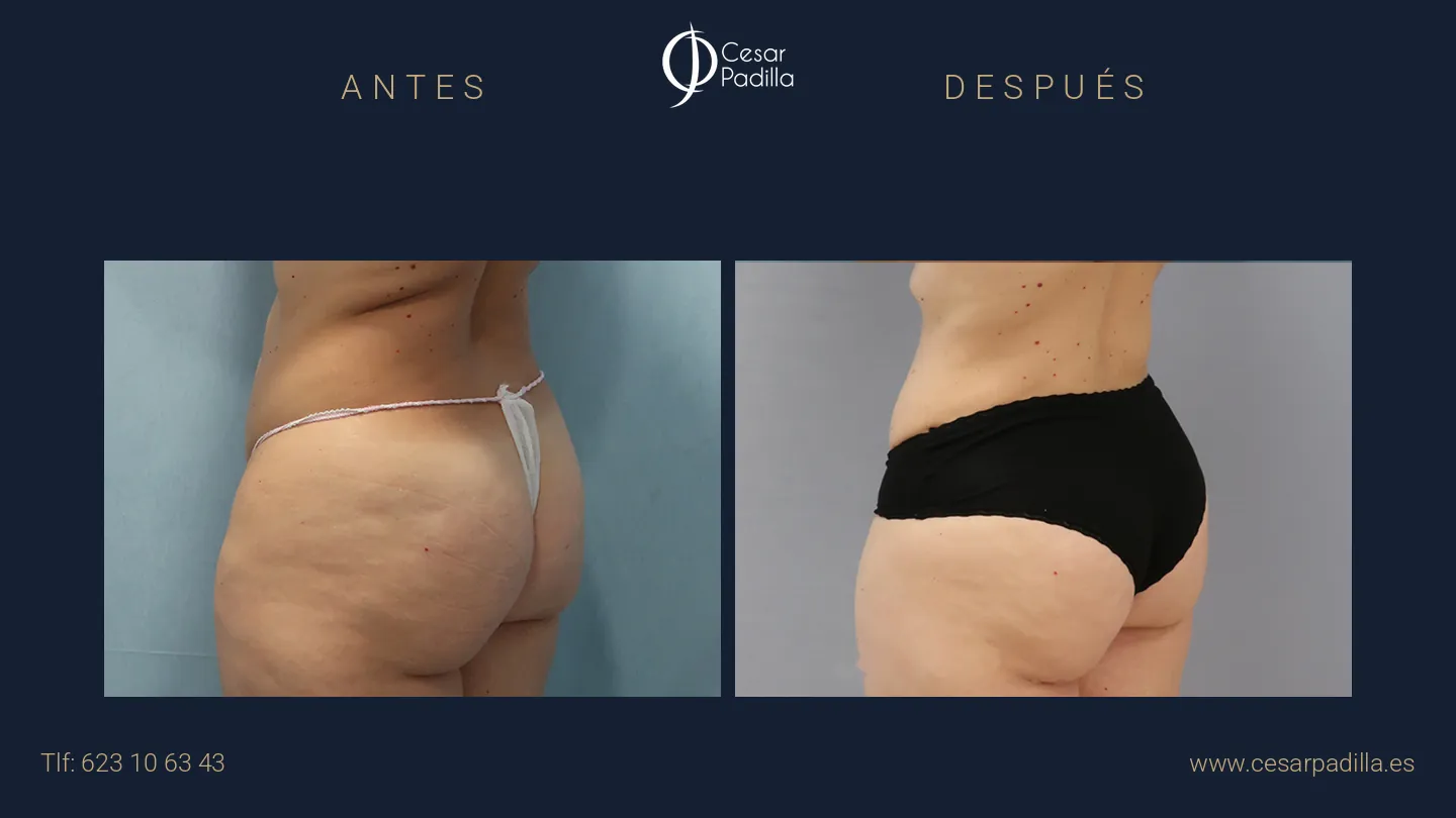 Antes y después de abdominoplastia, caso 24
