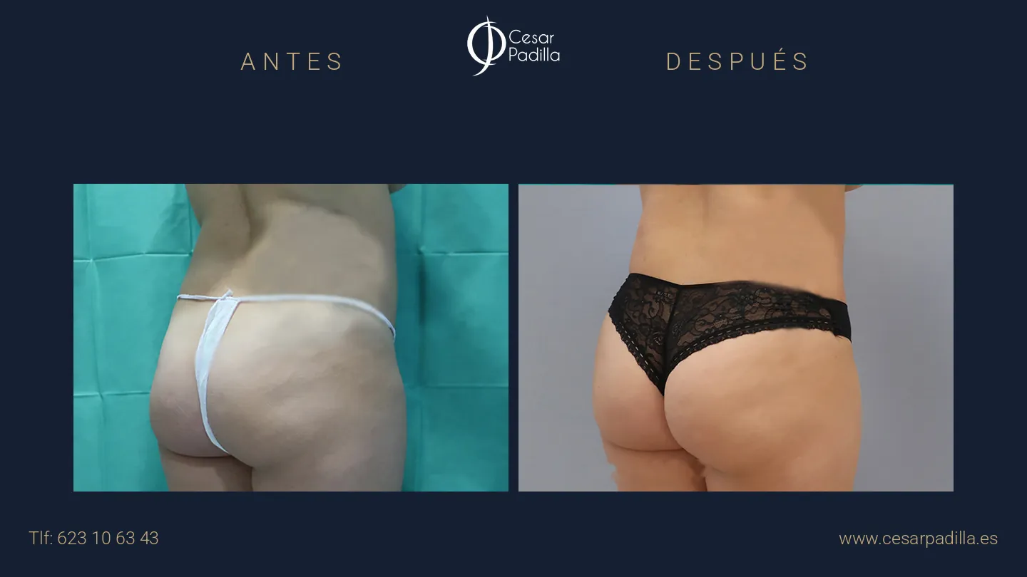 Antes y después de abdominoplastia, caso 25