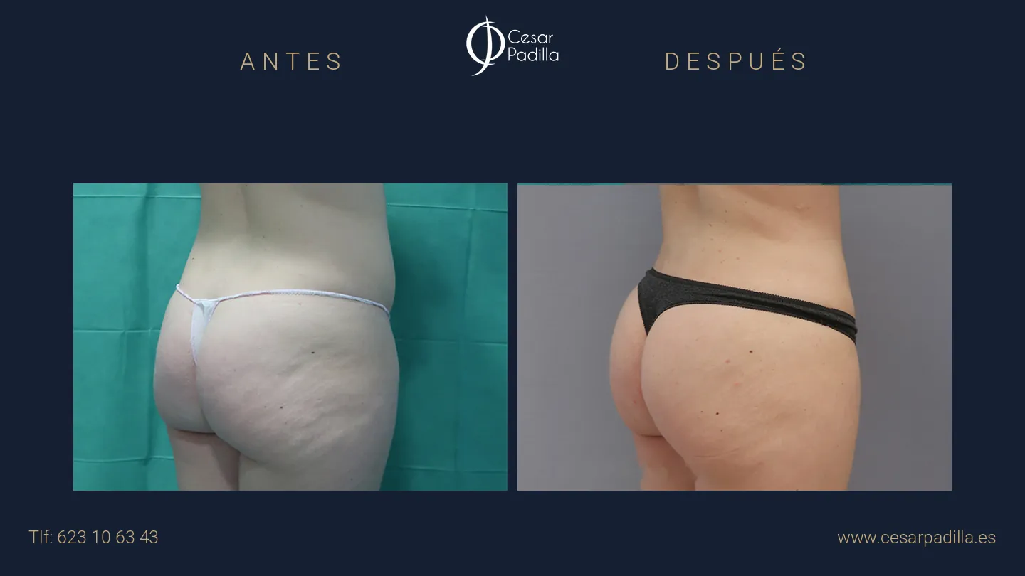 Antes y después de abdominoplastia, caso 26