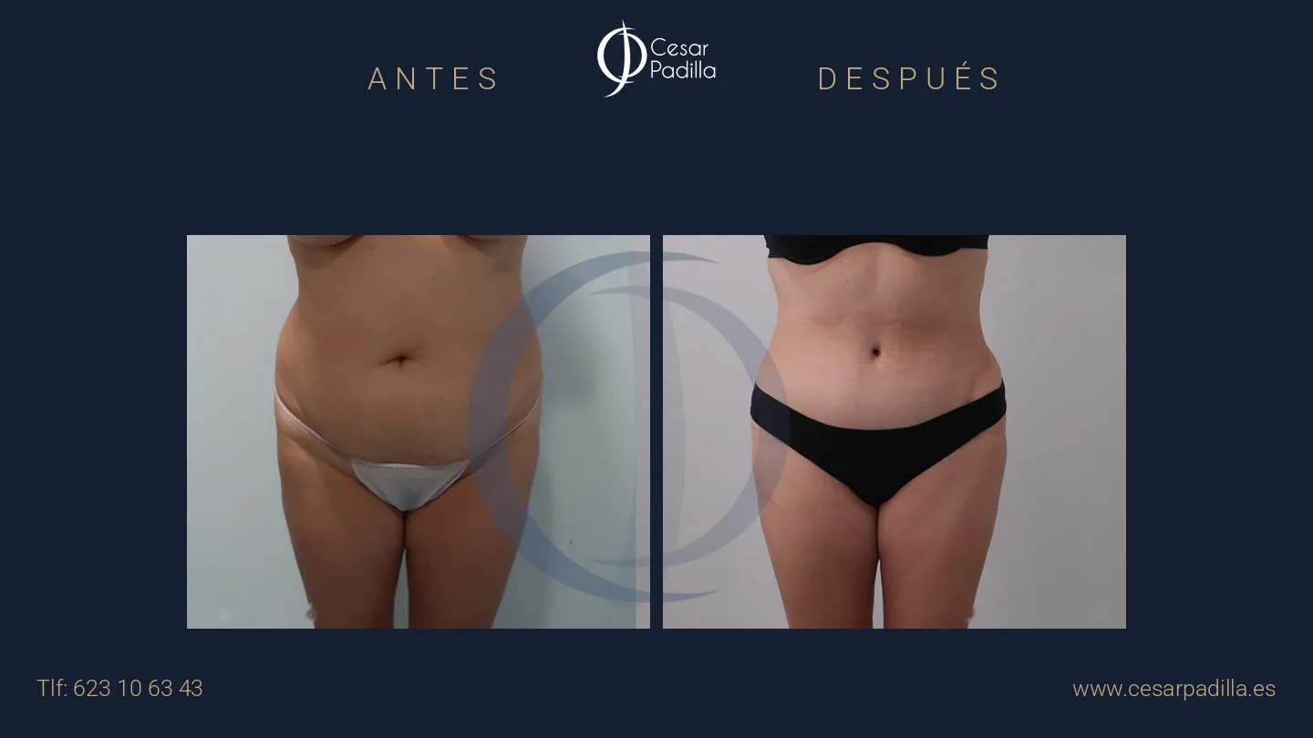 Antes y después de abdominoplastia, caso 27