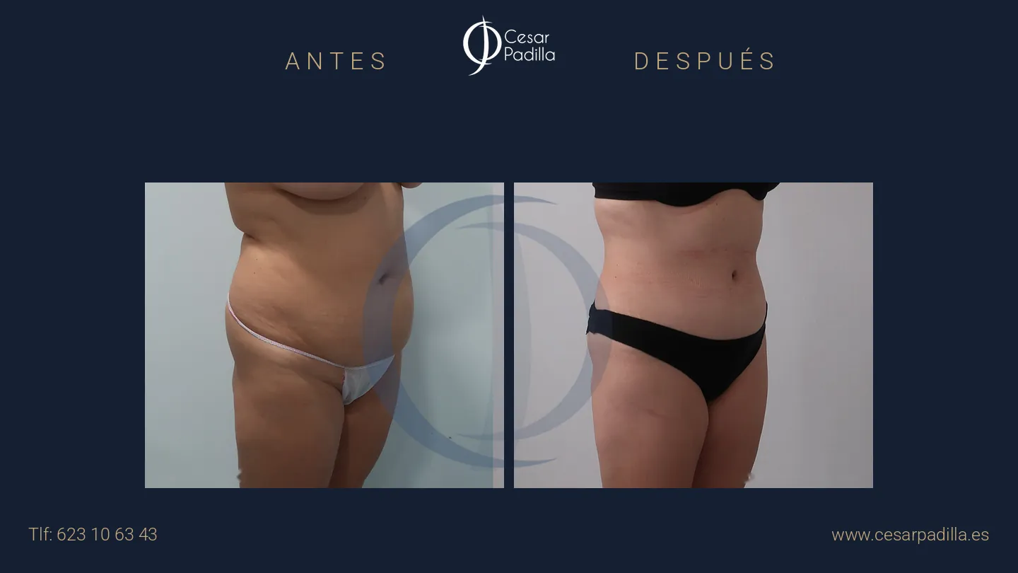 Antes y después de abdominoplastia, caso 28
