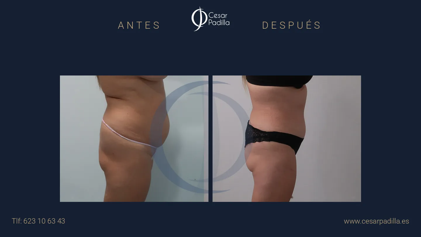 Antes y después de abdominoplastia, caso 29