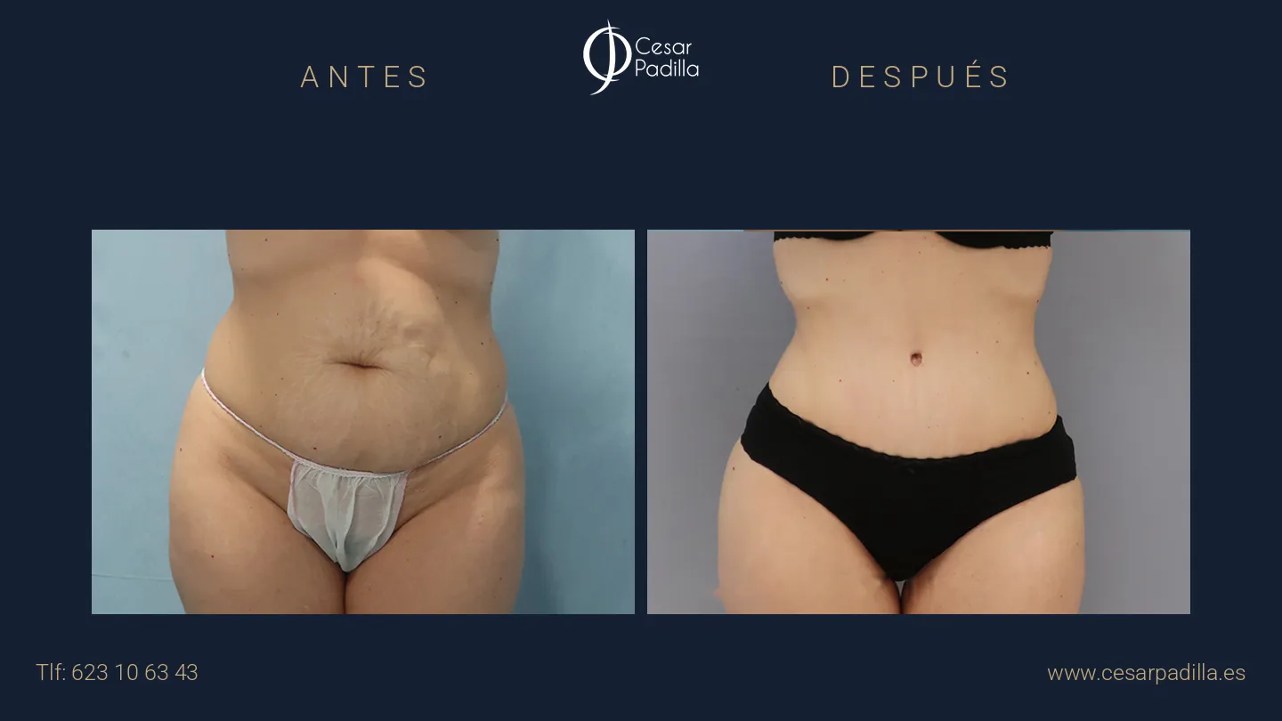 Antes y después de Abdominoplastia