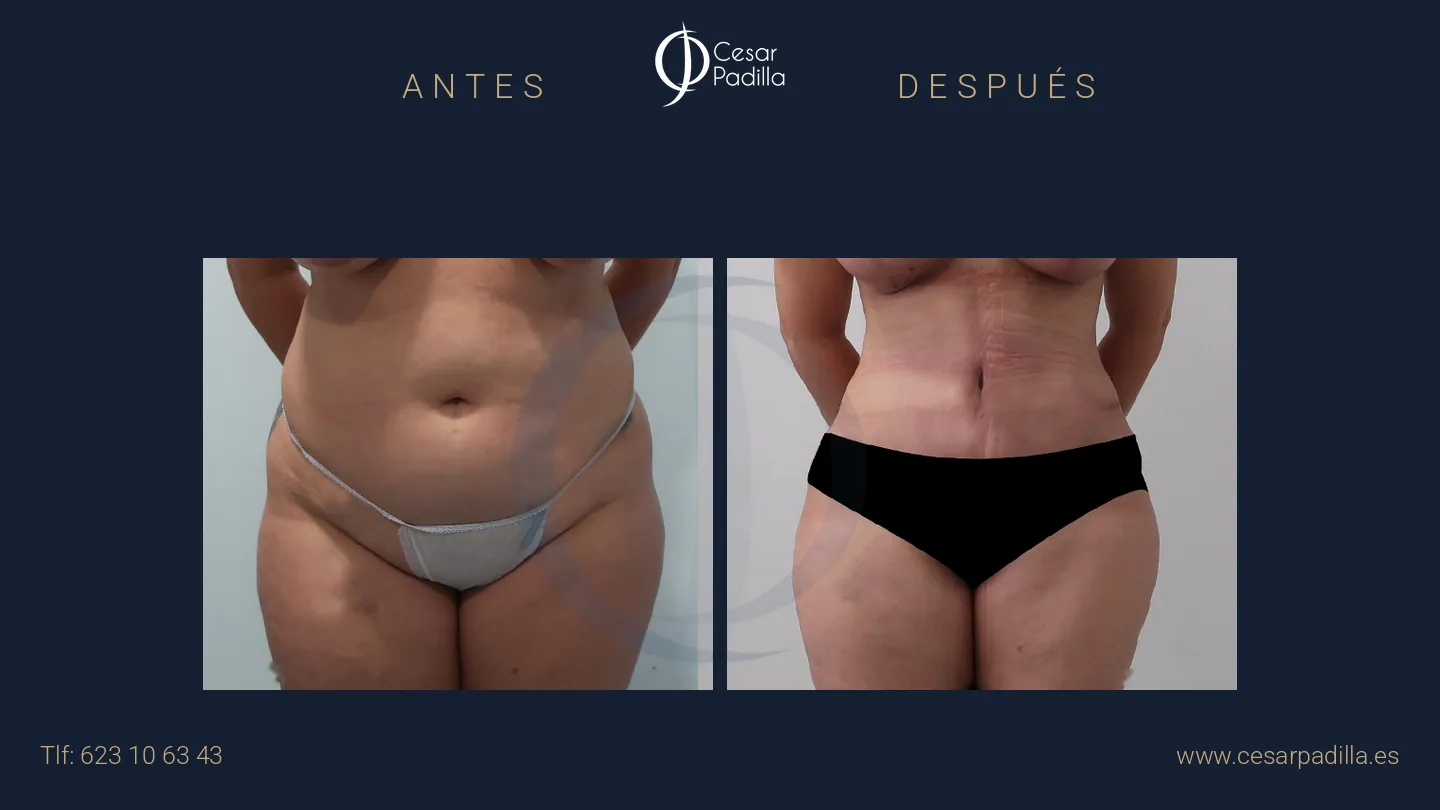Antes y después de abdominoplastia, caso 30