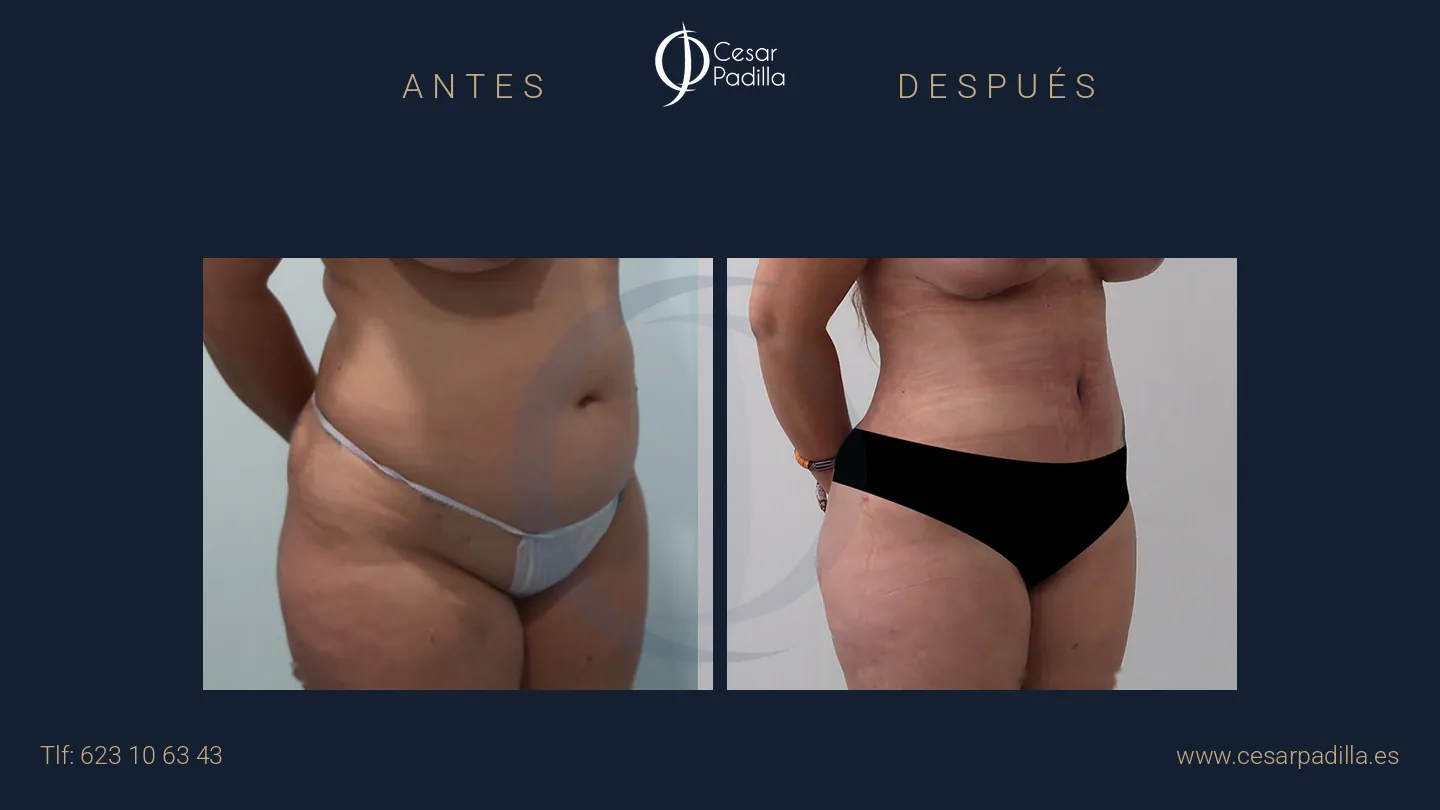 Antes y después de abdominoplastia, caso 31