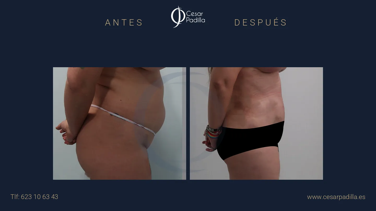 Antes y después de abdominoplastia, caso 32