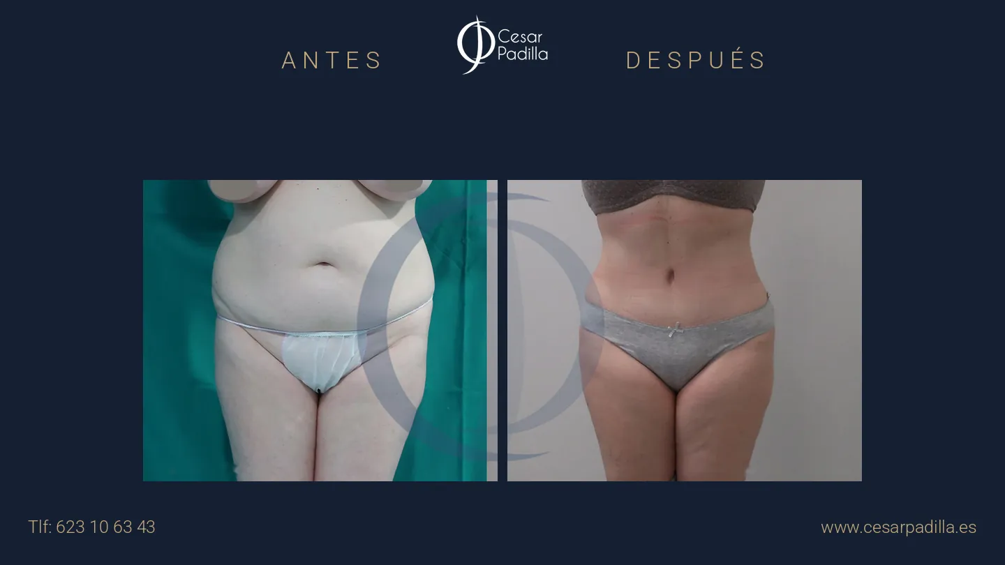 Antes y después de abdominoplastia, caso 33