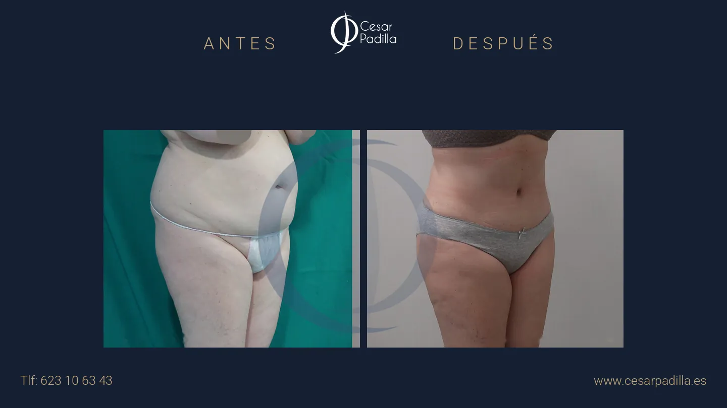 Antes y después de abdominoplastia, caso 34