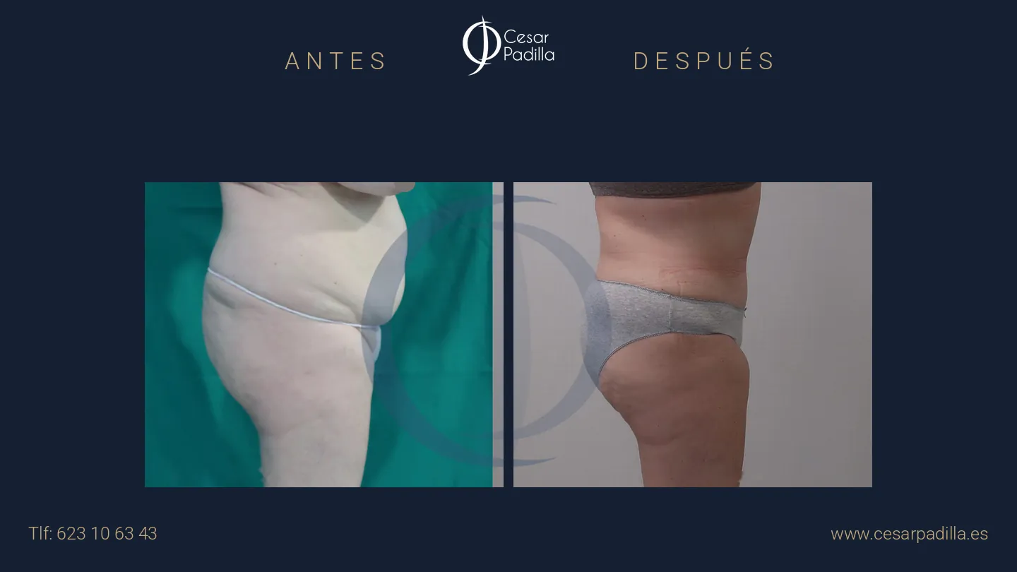 Antes y después de abdominoplastia, caso 35
