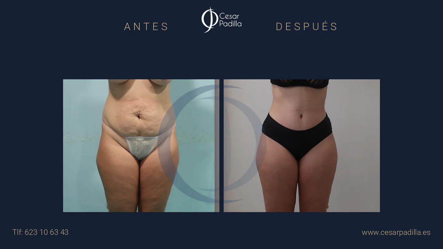 Antes y después de abdominoplastia, caso 36