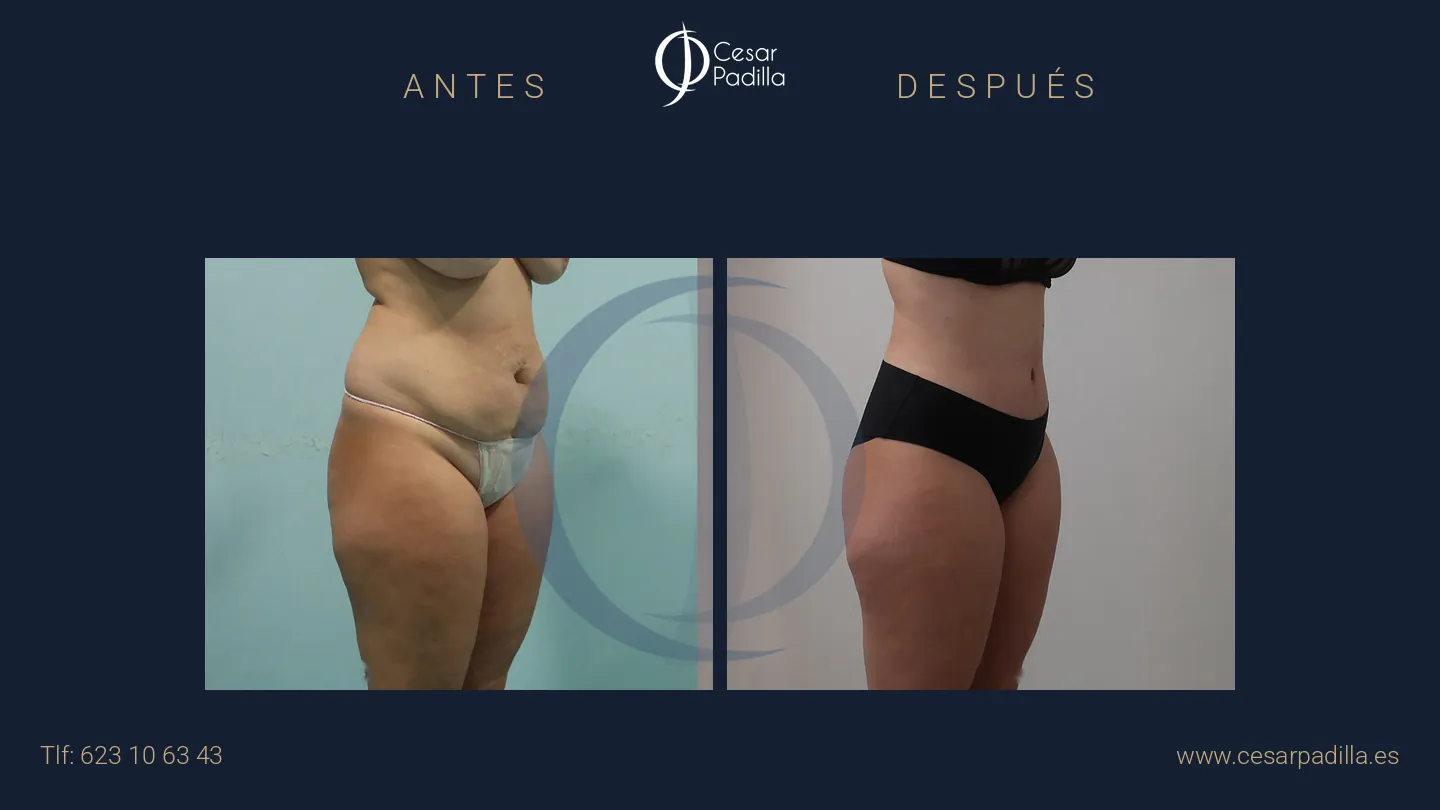 Antes y después de abdominoplastia, caso 37