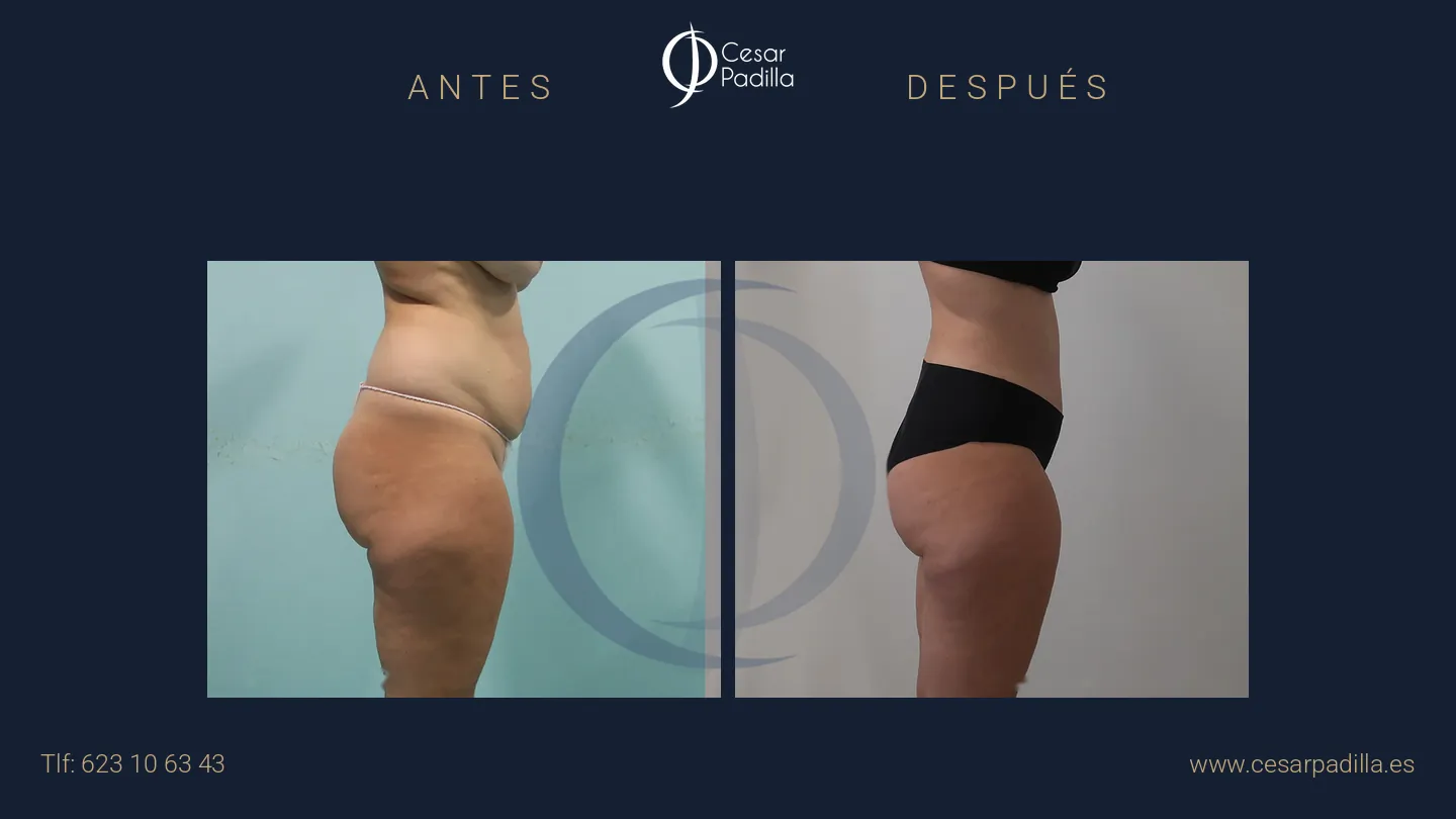 Antes y después de abdominoplastia, caso 38
